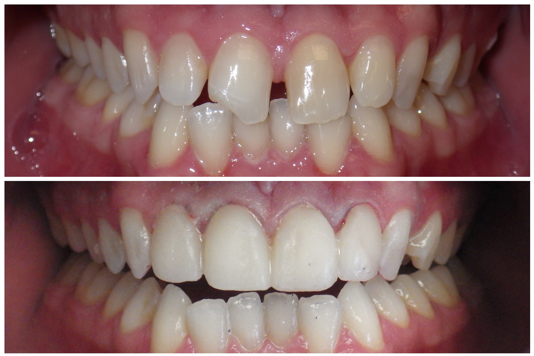 will veneers fix crooked teeth